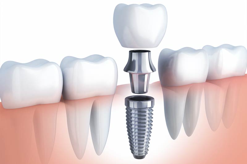 Ponchatoula Family Dentistry Special Offer