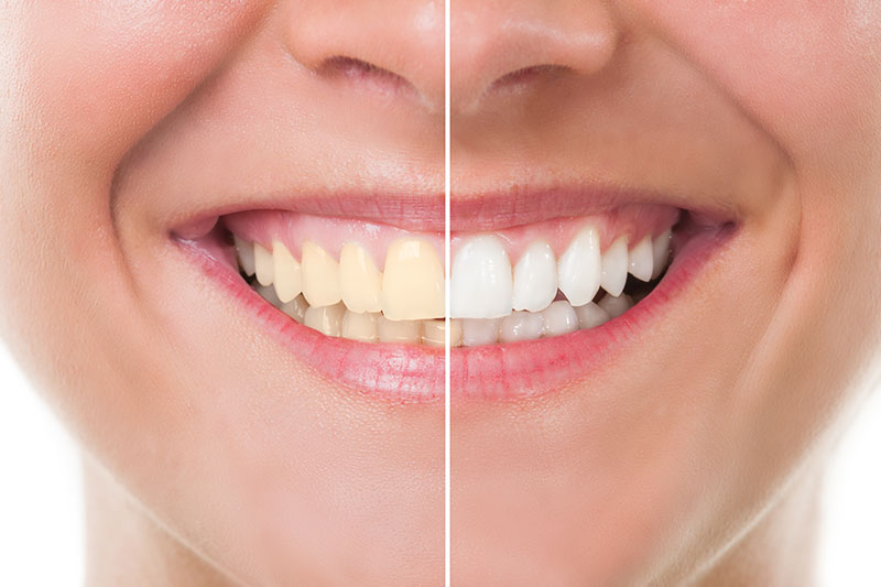 Teeth Whitening in Ponchatoula